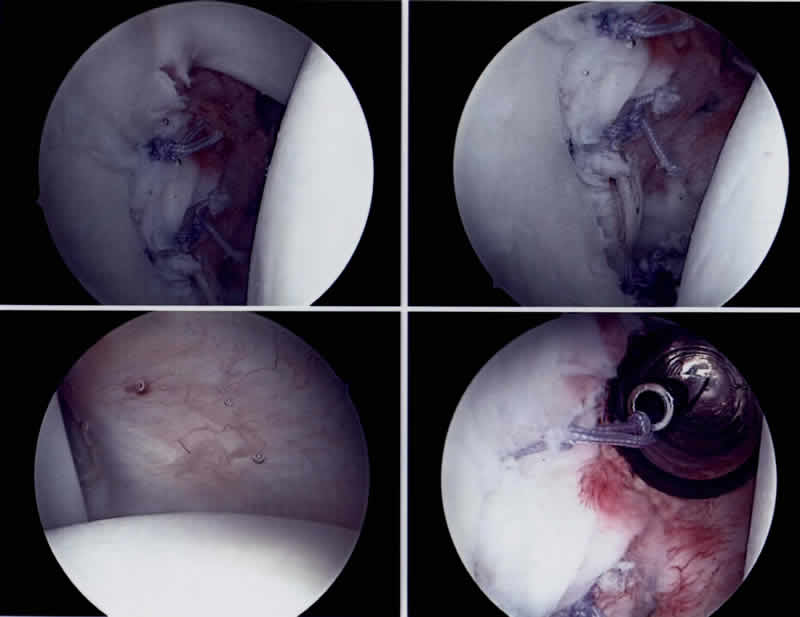 Bildserie einer arthroskopisch durchgeführten Schulterstabilisierung